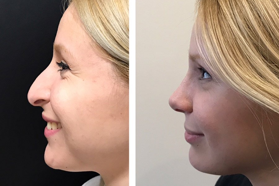 Evaluación de la nariz y el perfil facial para una rinoplastia