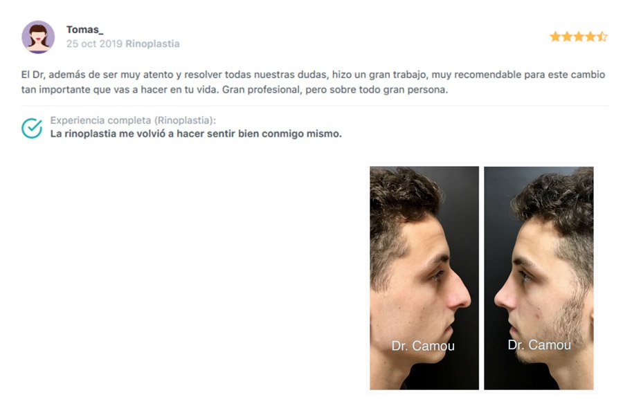 emiliano camou rinoplastias rosario _ testimonio_3