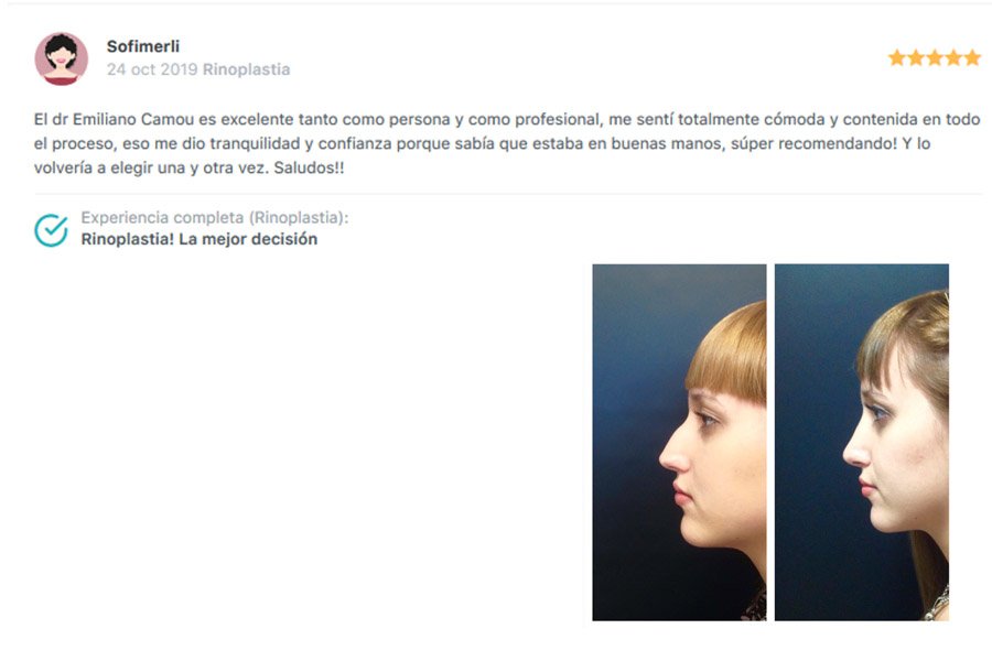 emiliano camou rinoplastias rosario _ testimonio_4