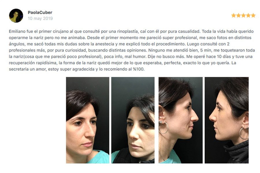emiliano camou rinoplastias rosario _ testimonio_5