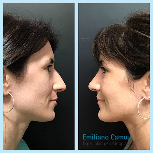 Rinoplastia emiliano camou _1