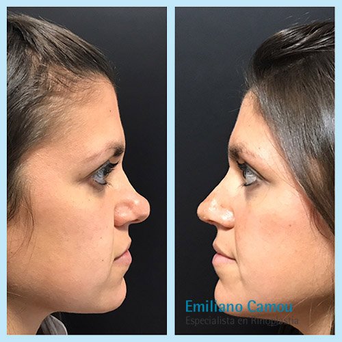 Rinoplastia emiliano camou _10.JPG
