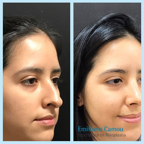 Rinoplastia emiliano camou _11.JPG