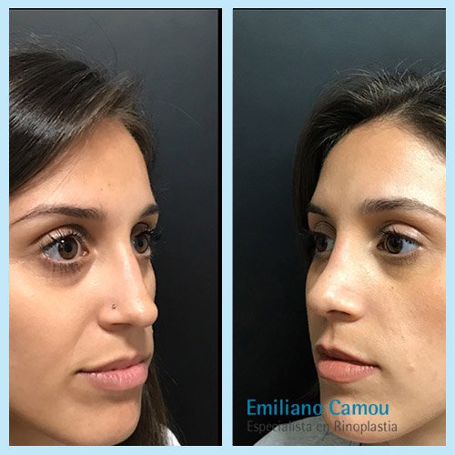 Rinoplastia emiliano camou _2.JPG