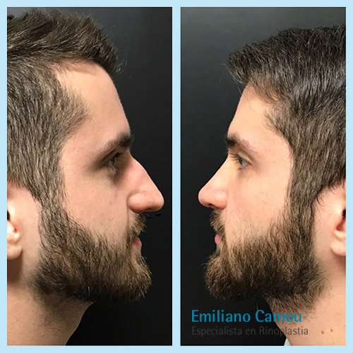 Rinoplastia emiliano camou _3.JPG
