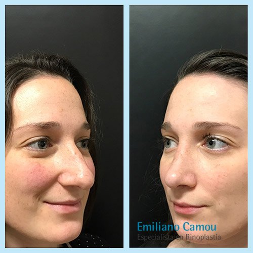 Rinoplastia emiliano camou _4.JPG