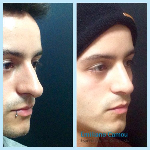 Rinoplastia emiliano camou _5.JPG
