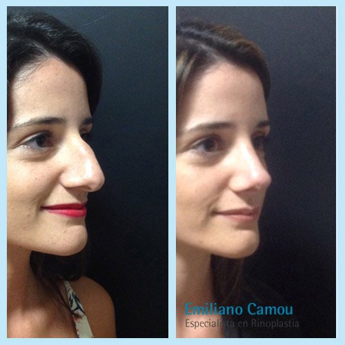 Rinoplastia emiliano camou _6.JPG