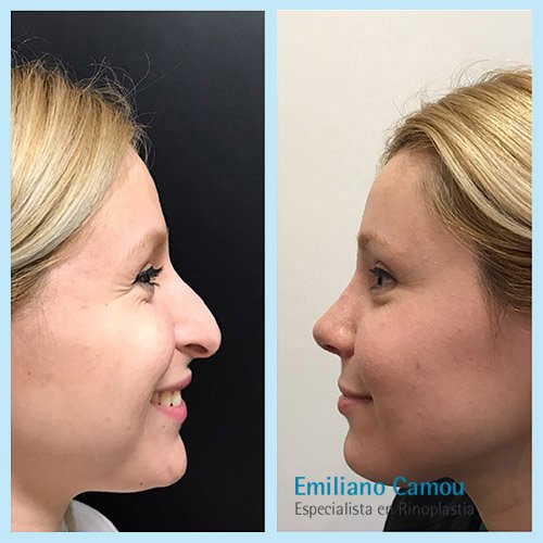 Rinoplastia emiliano camou _8.JPG