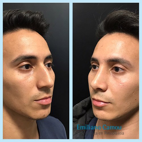 Rinoplastia emiliano camou _9.JPG